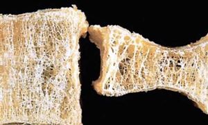 10个问题自测骨质疏松 我国低骨量人群超2亿 钙片市场调研及需求分析