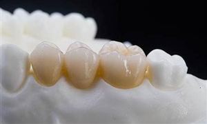 全瓷牙和烤瓷牙哪个好？全瓷牙多少钱一颗？未来全瓷牙市场规模预测​