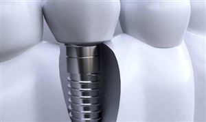 种植牙行业市场消费需求 种植牙行业市场规模分析