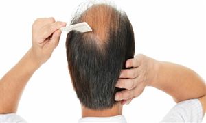 植发产业前景如何?深度聚焦植发产业分析