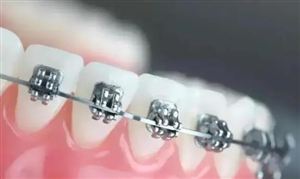 正畸托槽行业市场分析 2023正畸托槽企业发展现及市场规模预测