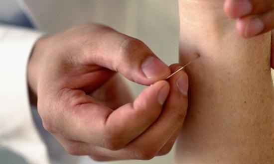 全球针灸针行业市场供需现状及未来趋势预测2023