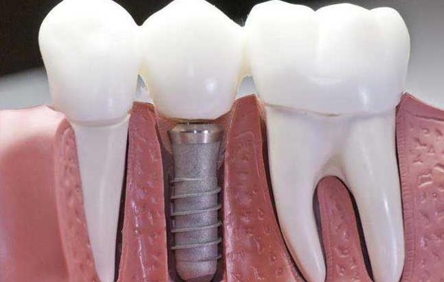 口腔种植体集采整体降价约60% 口腔种植体需求总量超过280万套