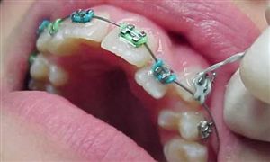 网购牙齿矫正器 真的靠谱吗 口腔正畸行业市场深度分析及发展策略研究报告