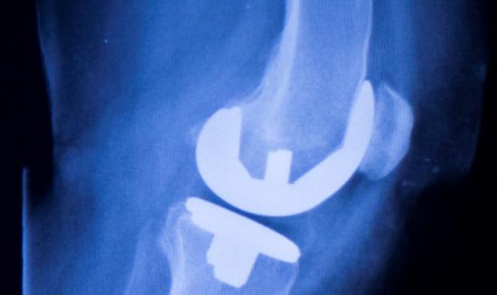 2023年中国骨科植入器材行业发展前景