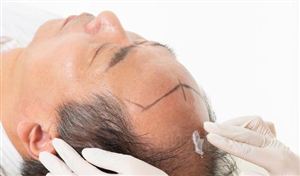 2023年植发行业市场发展现状分析