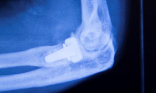 中国骨科植入器材行业发展前景2023