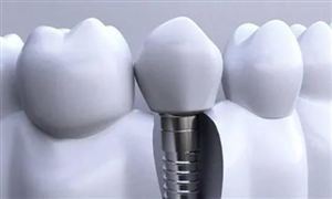 种植牙行业发展前景分析及市场空间：我国种植牙行业已进入爆发期 
