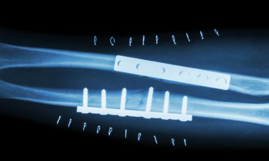 中国骨科植入器材行业发展趋势 中国骨科植入器材行业供需分析