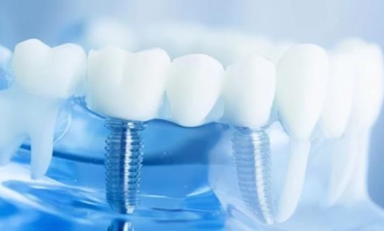种植牙集采带来利好 种植牙行业前景分析及投资机会