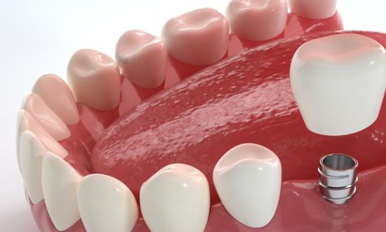2024种植牙行业发展现状趋势分析
