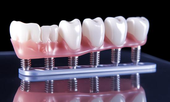 种植牙收费明显规范 2024种植牙行业市场深度分析