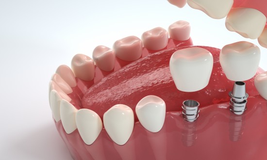 2024年中国种植牙行业发展现状及重点企业经营情况