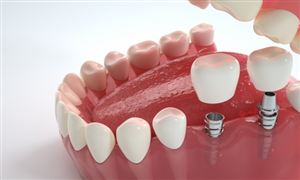 2024年中国种植牙行业发展现状及重点企业经营情况