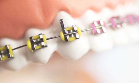 2024年中国正畸托槽行业的市场发展现状及重点企业情况