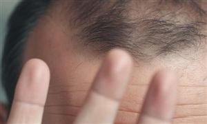 2024年中国植发行业市场前瞻与未来投资战略 植发经济火热背后的市场乱象与消费纠纷