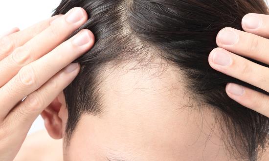 防脱发洗发露行业前景研究：中国防脱发市场价值逐年增长