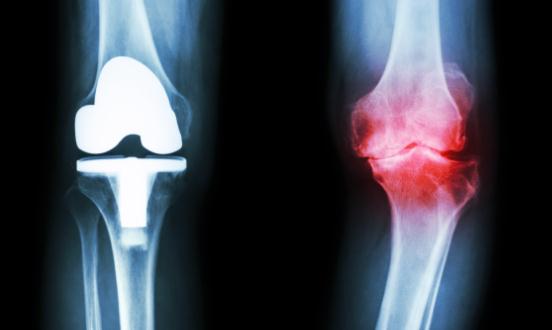 2024人工关节产业链上下游发展现状及竞争格局分析