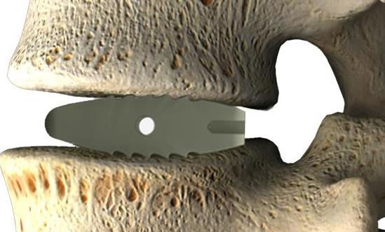 行业发展报告：预计到2029年颈椎椎间融合器市场规模将达85.16亿元